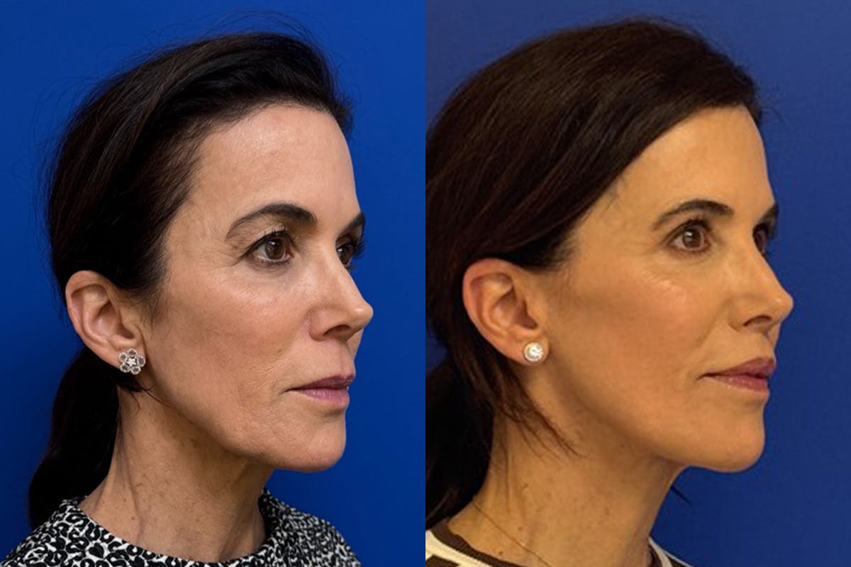 Facelift Before & After Gallery - Patient 145480 - Image 2