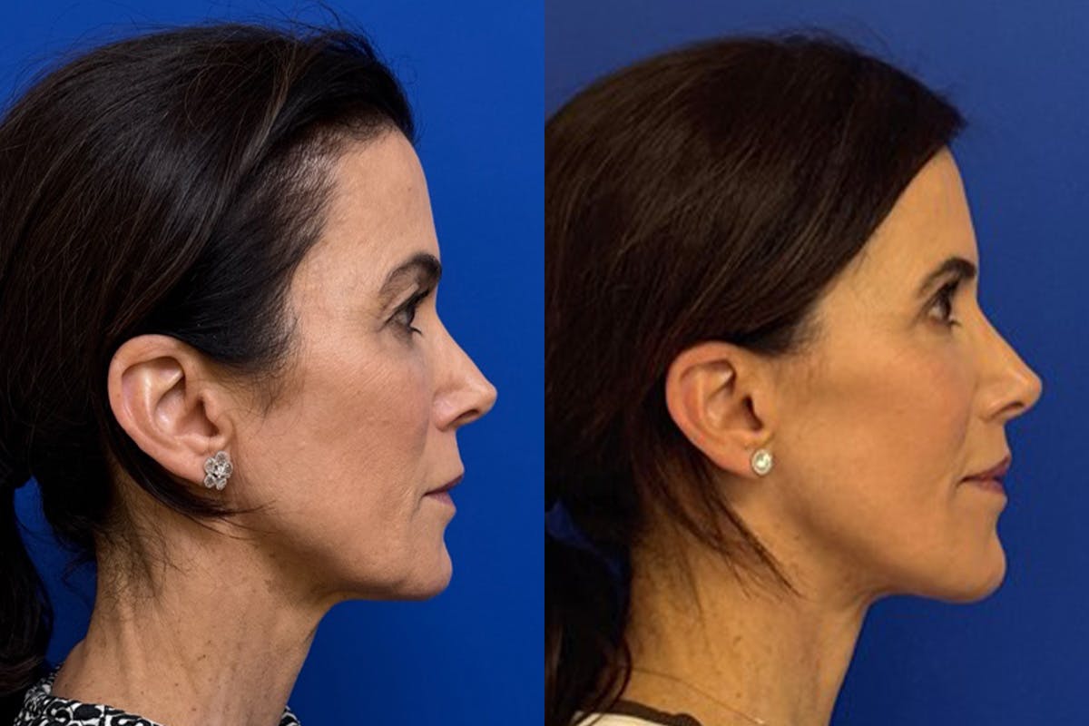 Facelift Before & After Gallery - Patient 145480 - Image 3