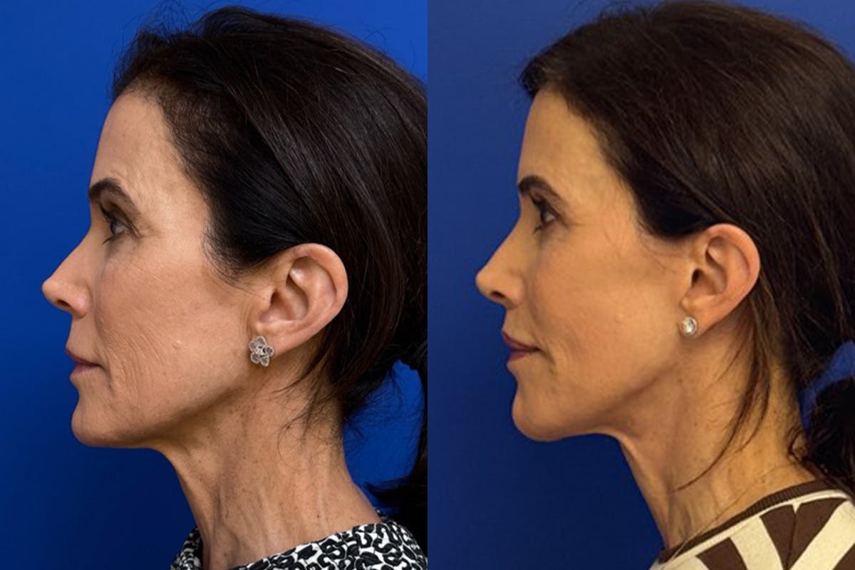Facelift Before & After Gallery - Patient 145480 - Image 4