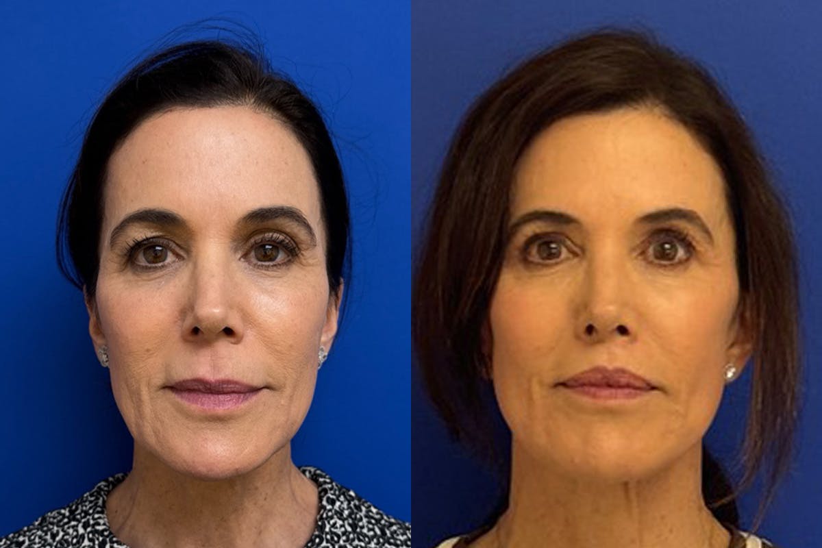Facelift Before & After Gallery - Patient 145480 - Image 1