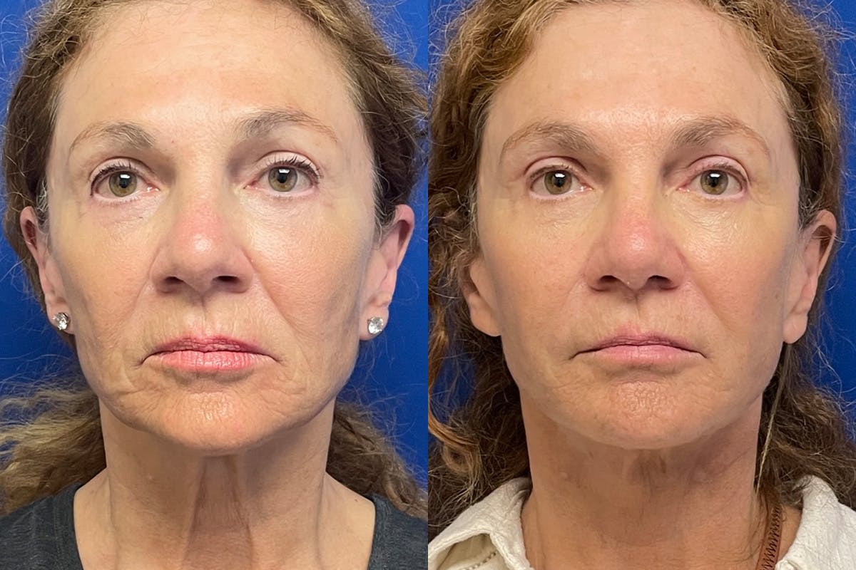 Facelift Before & After Gallery - Patient 489730 - Image 1
