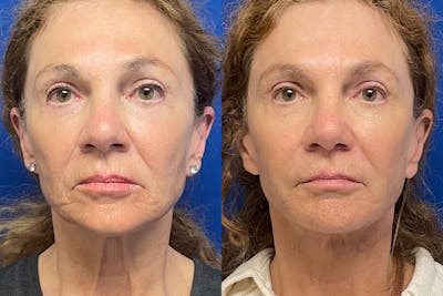 Facelift Before & After Gallery - Patient 489730 - Image 1