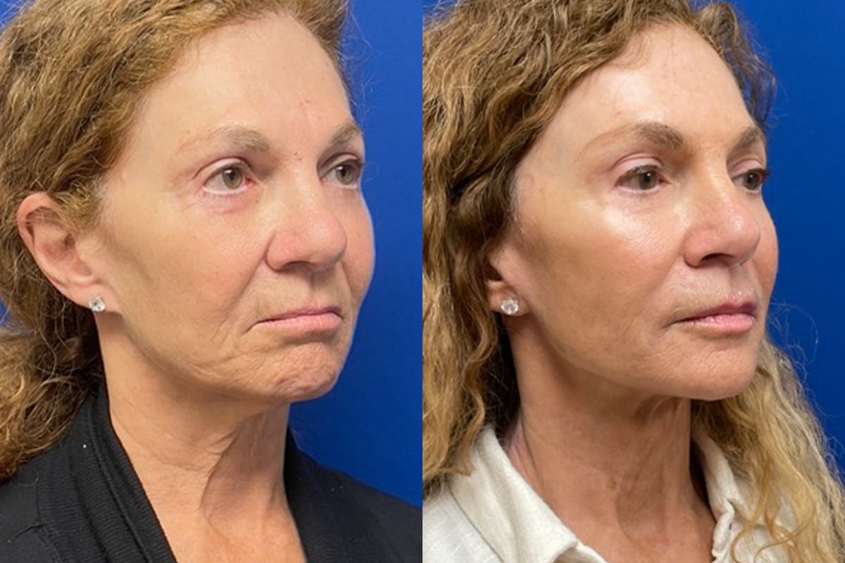 Facelift Before & After Gallery - Patient 489730 - Image 2