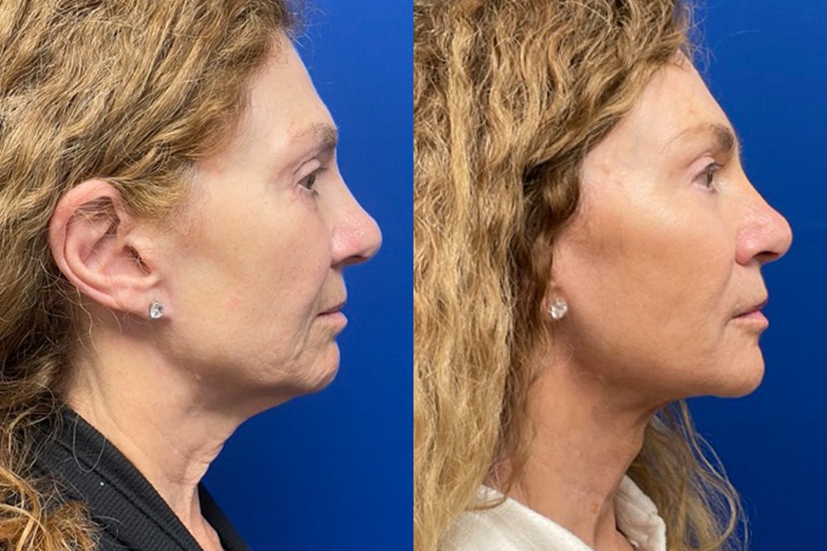 Facelift Before & After Gallery - Patient 489730 - Image 3