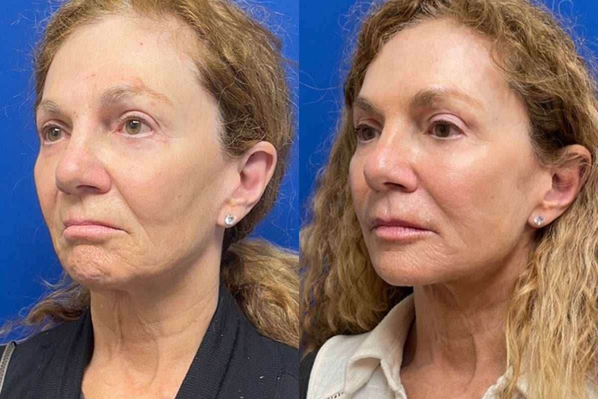 Facelift Before & After Gallery - Patient 489730 - Image 4