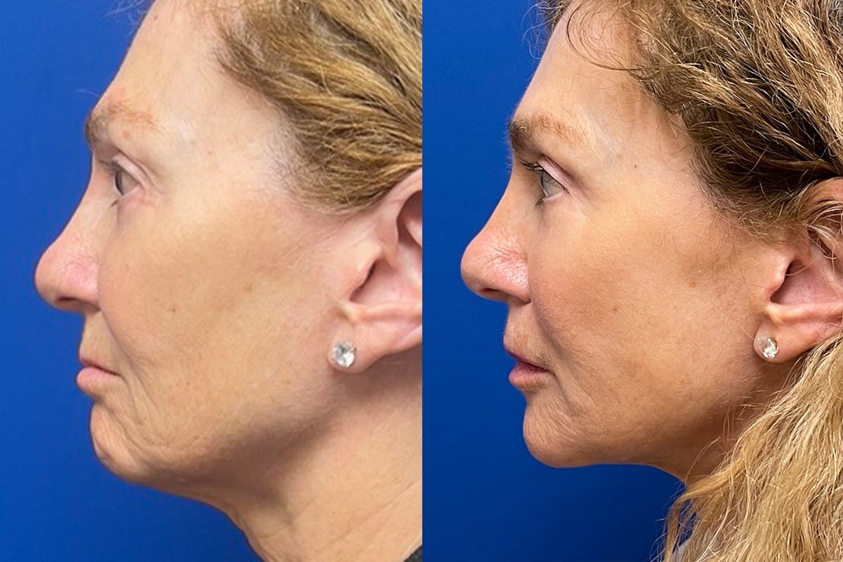 Facelift Before & After Gallery - Patient 489730 - Image 5
