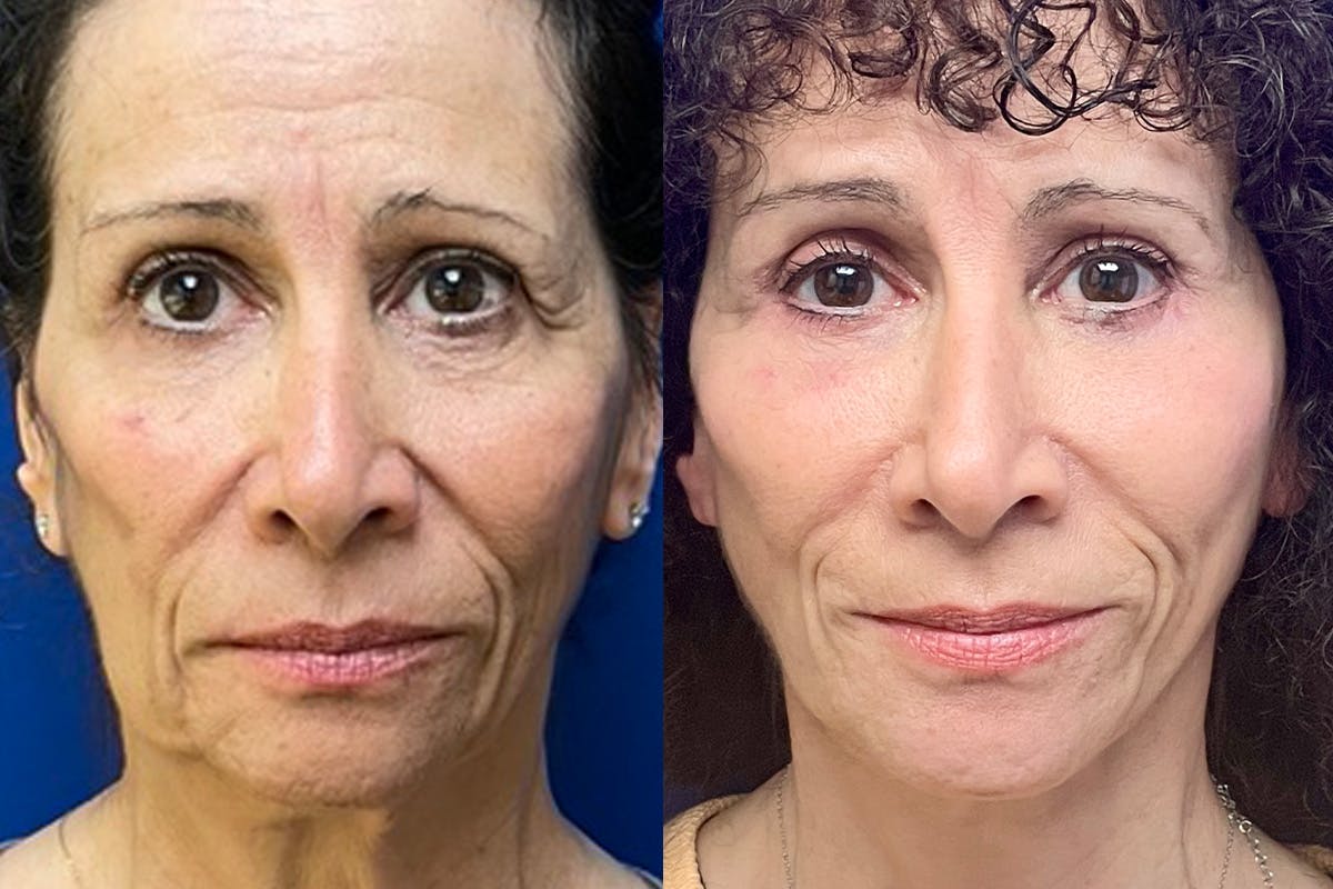 Facelift Before & After Gallery - Patient 289062 - Image 1
