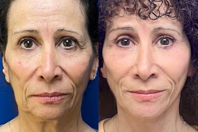 Facelift Before & After Gallery - Patient 289062 - Image 1