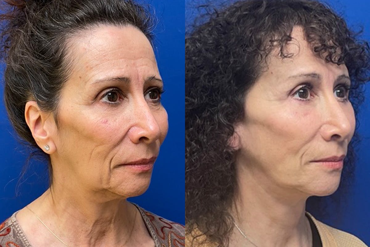 Facelift Before & After Gallery - Patient 289062 - Image 2