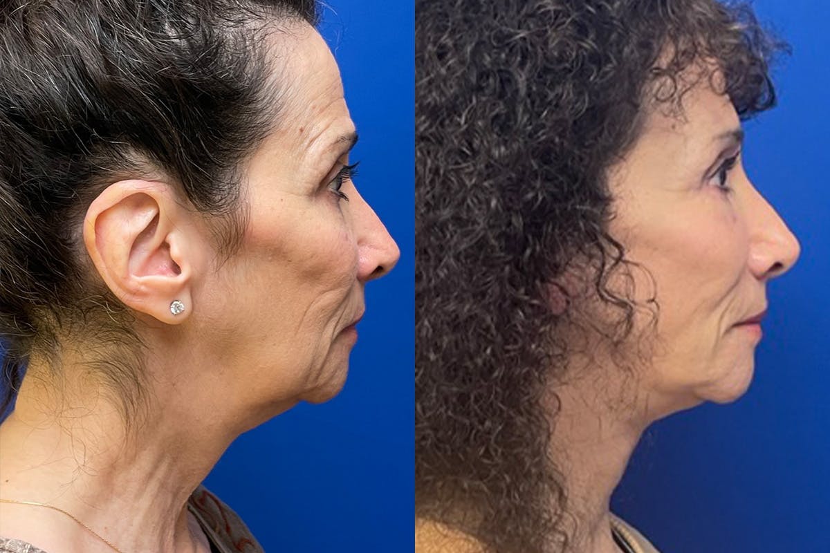 Facelift Before & After Gallery - Patient 289062 - Image 3