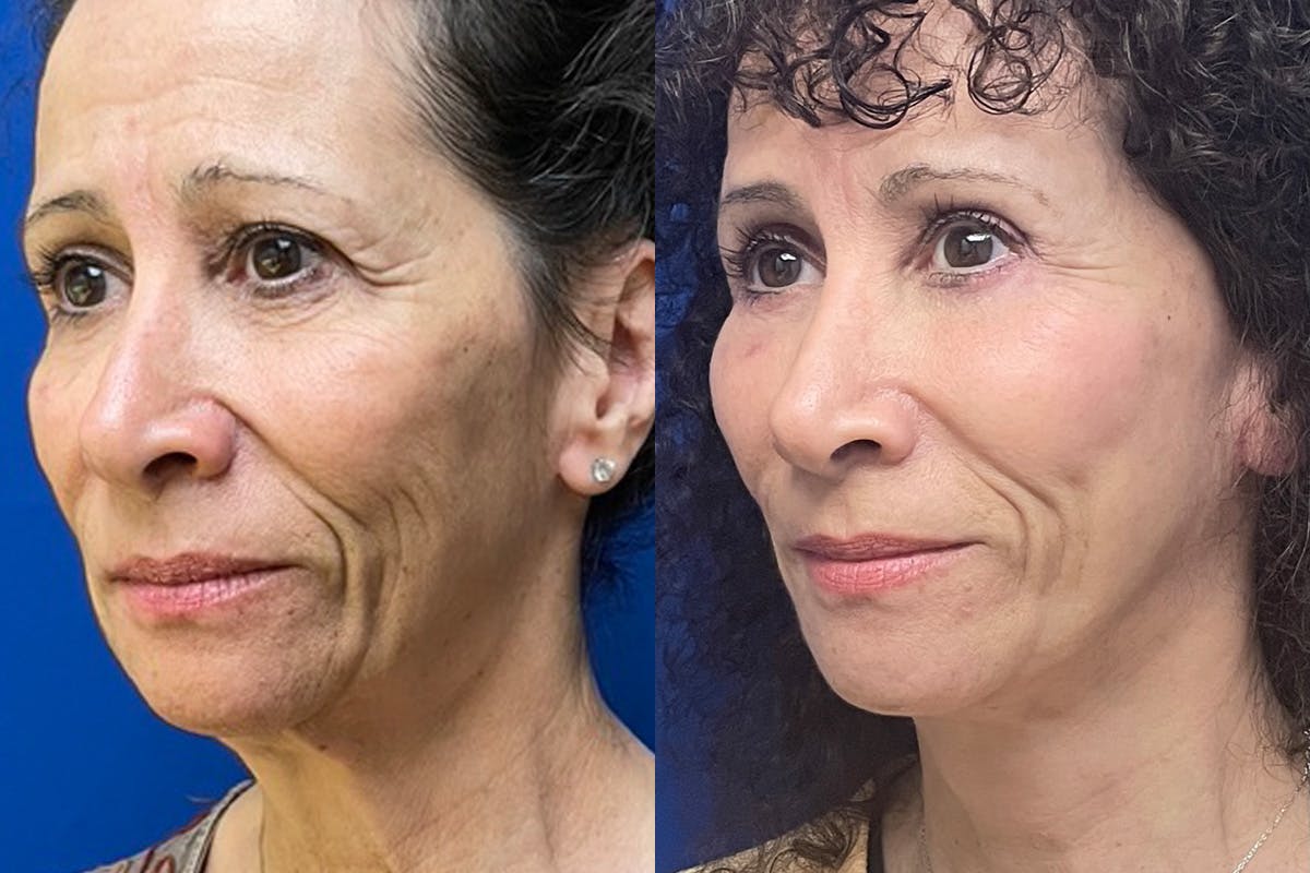 Facelift Before & After Gallery - Patient 289062 - Image 4