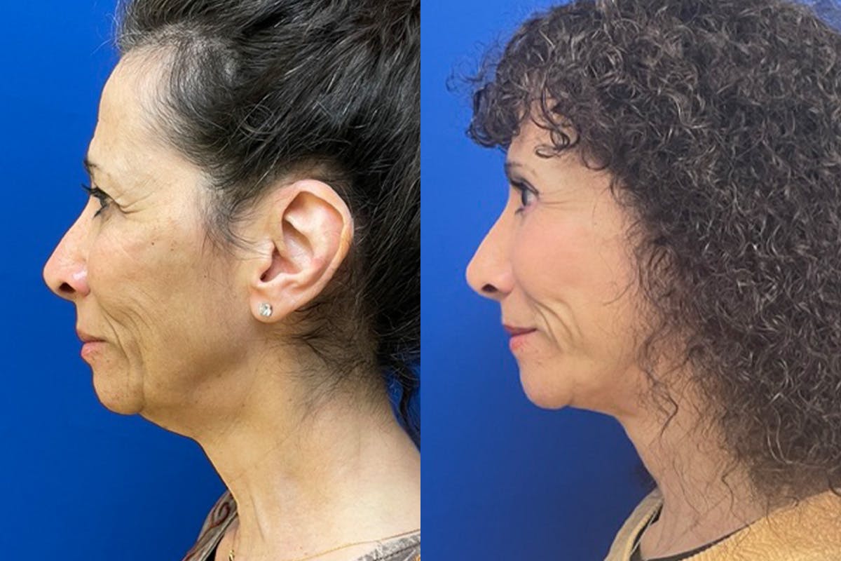 Facelift Before & After Gallery - Patient 289062 - Image 5