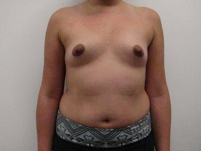 隆胸前后图库-患者120902454 -图1
