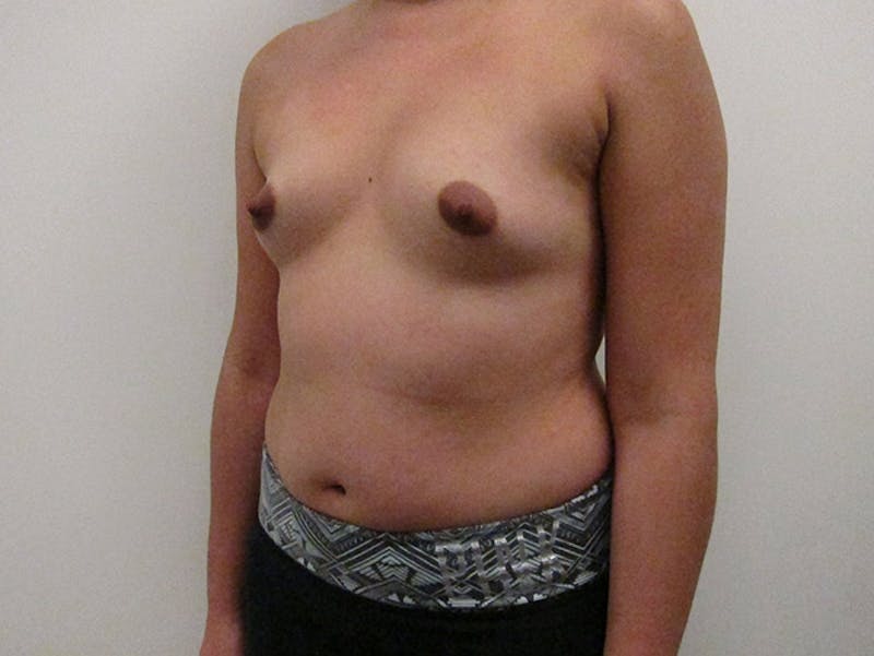 Breast Augmentation Before & After Gallery - Patient 120902454 - Image 3