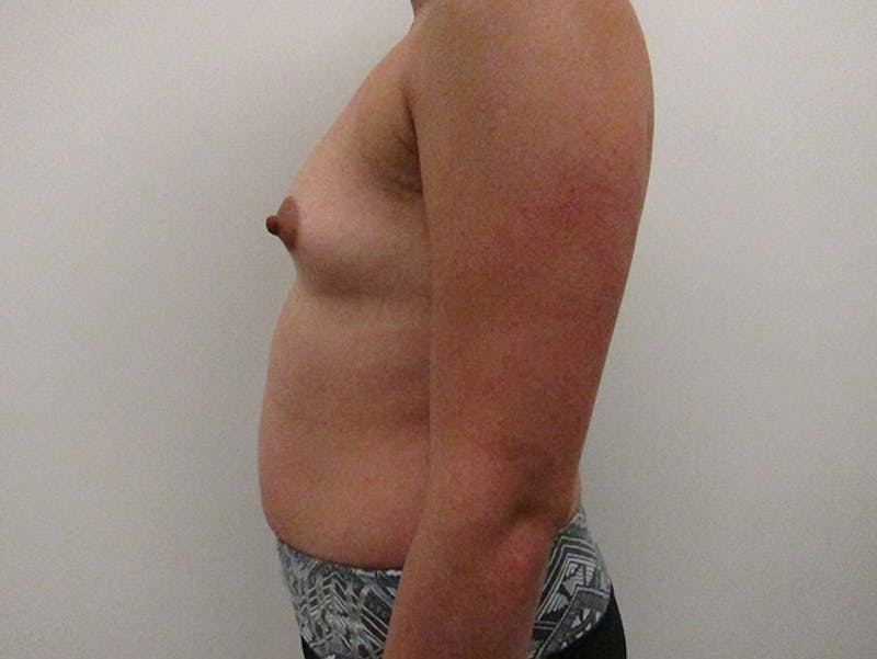 Breast Augmentation Before & After Gallery - Patient 120902454 - Image 5