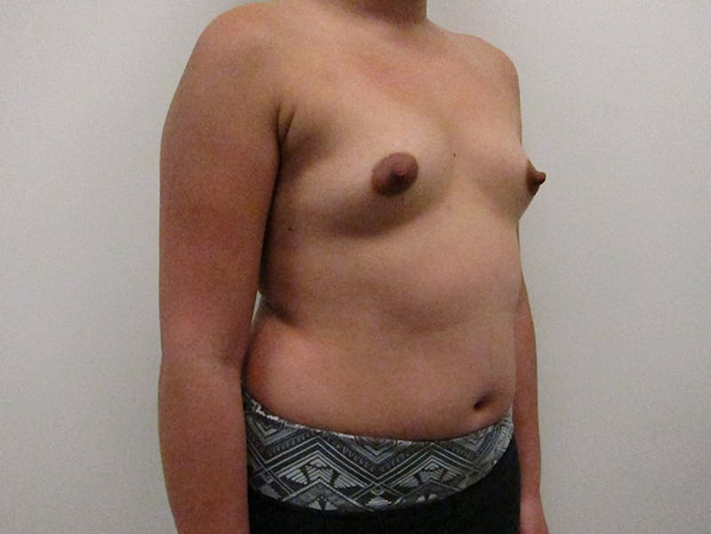 Breast Augmentation Before & After Gallery - Patient 120902454 - Image 7