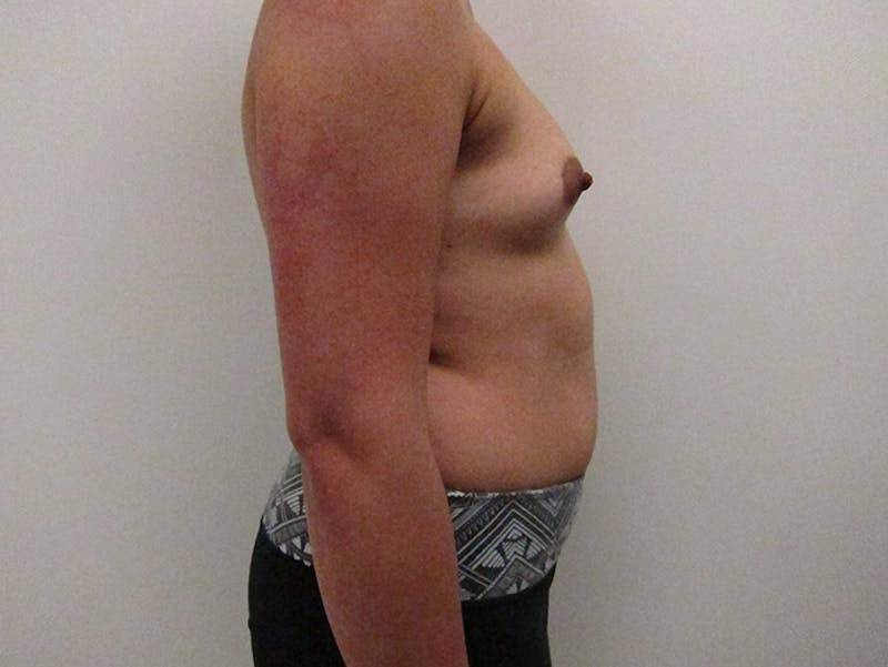 Breast Augmentation Before & After Gallery - Patient 120902454 - Image 9