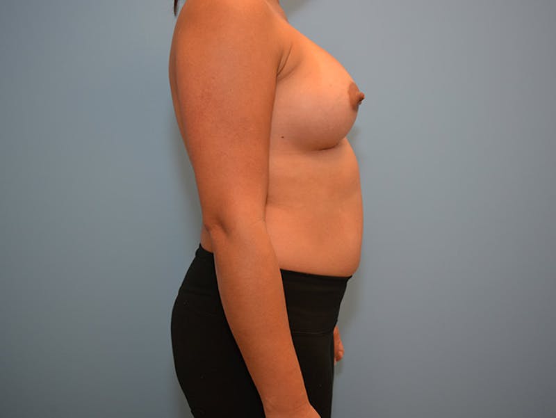 Breast Augmentation Before & After Gallery - Patient 120902454 - Image 10