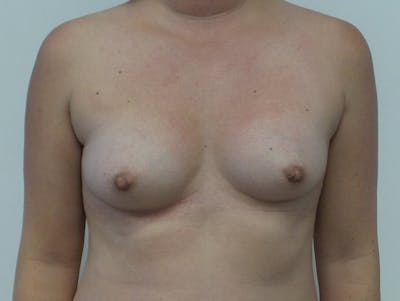Breast Augmentation Before & After Gallery - Patient 120902466 - Image 1