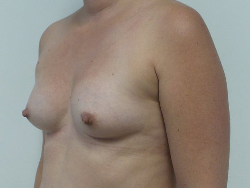 Breast Augmentation Before & After Gallery - Patient 120902466 - Image 3