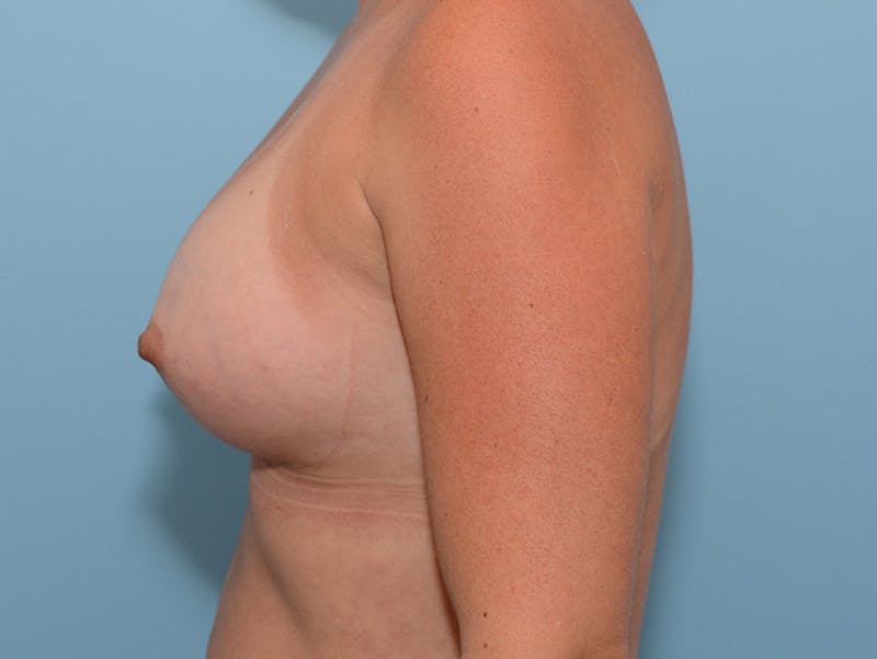 Breast Augmentation Gallery - Patient 120902466 - Image 6