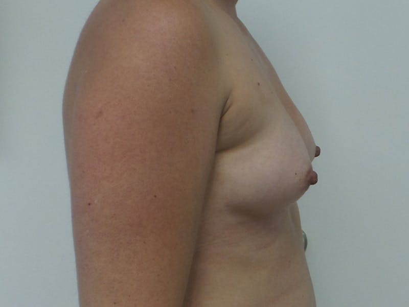Breast Augmentation Before & After Gallery - Patient 120902466 - Image 9