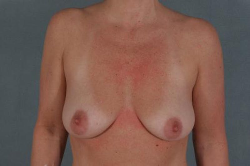 Breast Augmentation Before & After Gallery - Patient 120902481 - Image 1