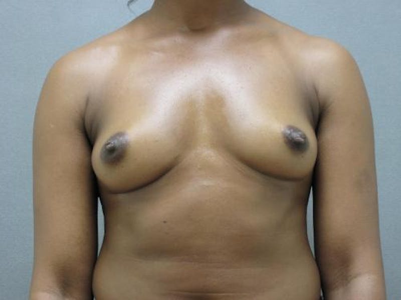 Breast Augmentation Before & After Gallery - Patient 120902484 - Image 1