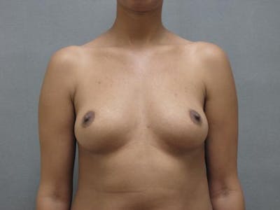 隆胸前后图库-患者120902496 -图片1