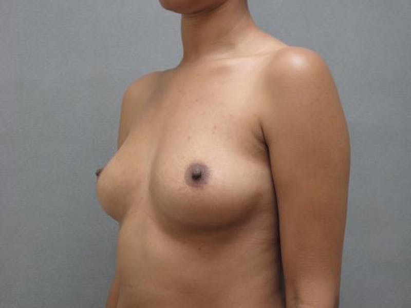 Breast Augmentation Before & After Gallery - Patient 120902496 - Image 5