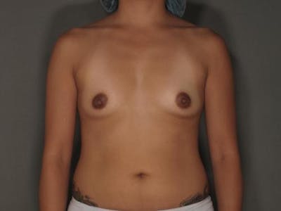 隆胸前后图库-患者120902501 -图1