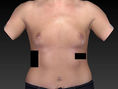 Breast Augmentation Before & After Gallery - Patient 120902517 - Image 1