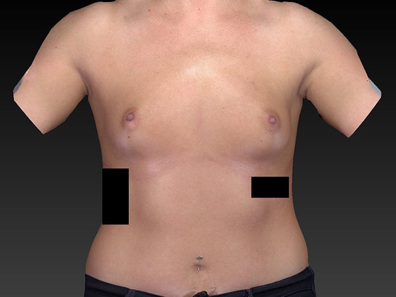 Breast Augmentation Before & After Gallery - Patient 120902517 - Image 1