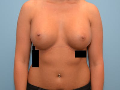 隆胸前后图库-患者120902517 -图2