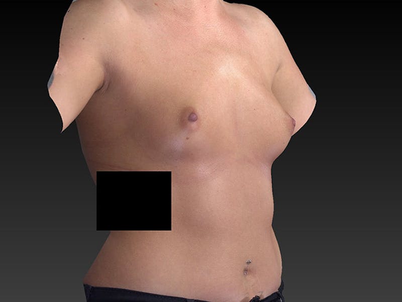 Breast Augmentation Before & After Gallery - Patient 120902517 - Image 3