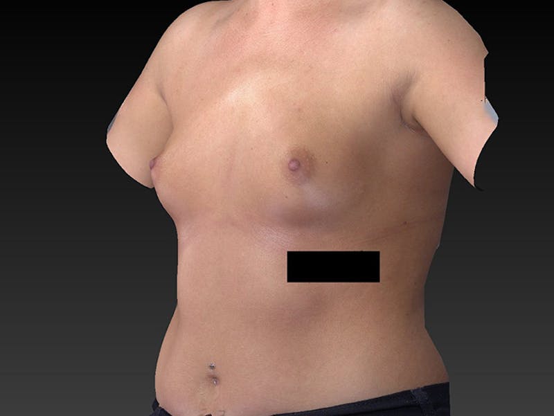 Breast Augmentation Before & After Gallery - Patient 120902517 - Image 5