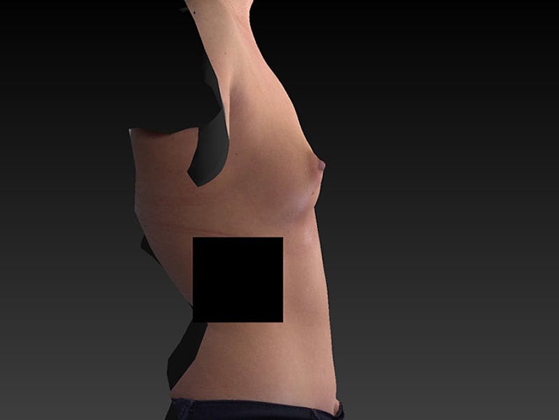 Breast Augmentation Before & After Gallery - Patient 120902517 - Image 7