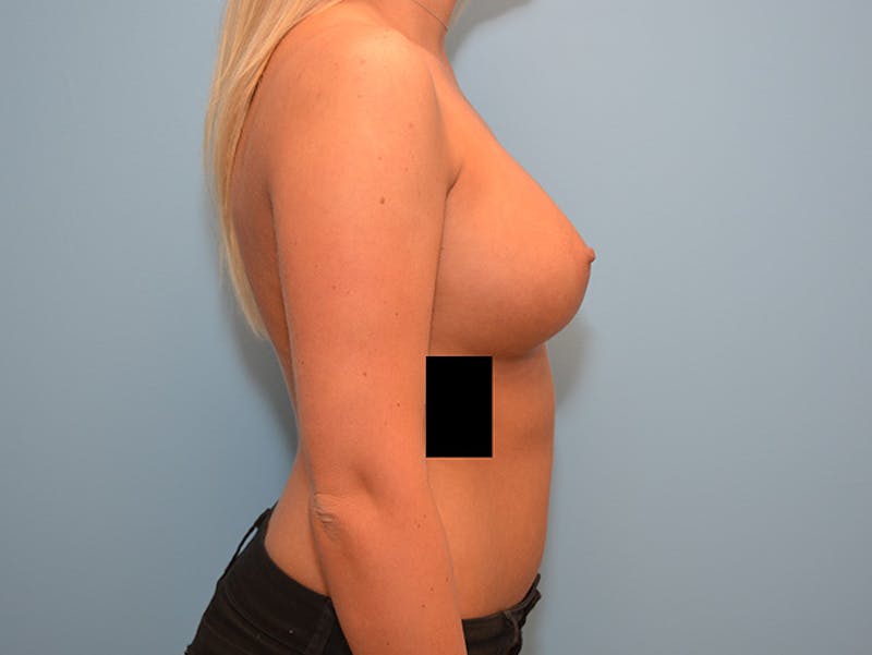 Breast Augmentation Before & After Gallery - Patient 120902517 - Image 8