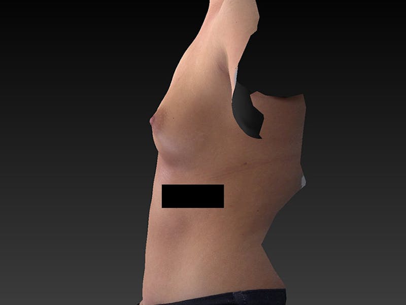 Breast Augmentation Before & After Gallery - Patient 120902517 - Image 9