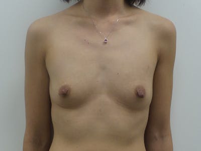 Breast Augmentation Before & After Gallery - Patient 120902535 - Image 1