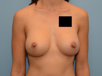 隆胸前后图库-患者120902535 -图2