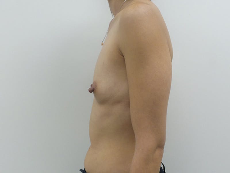 Breast Augmentation Before & After Gallery - Patient 120902535 - Image 7