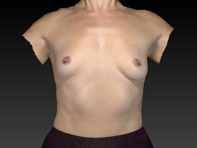 Breast Augmentation Before & After Gallery - Patient 120902542 - Image 1