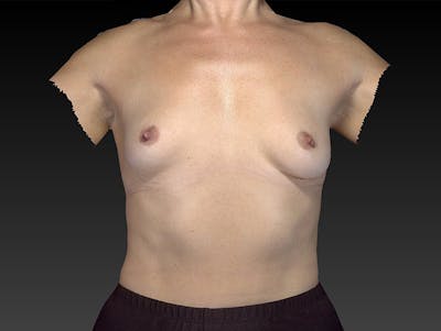 隆胸前后画廊-病人120902542 -图片1