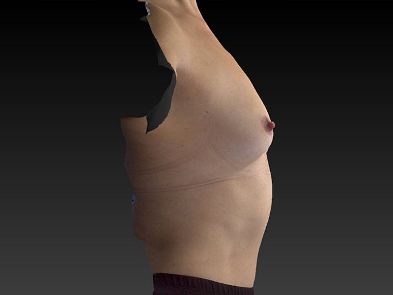 Breast Augmentation Before & After Gallery - Patient 120902542 - Image 3