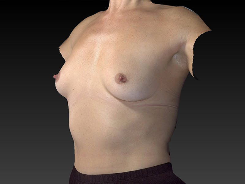 Breast Augmentation Before & After Gallery - Patient 120902542 - Image 7