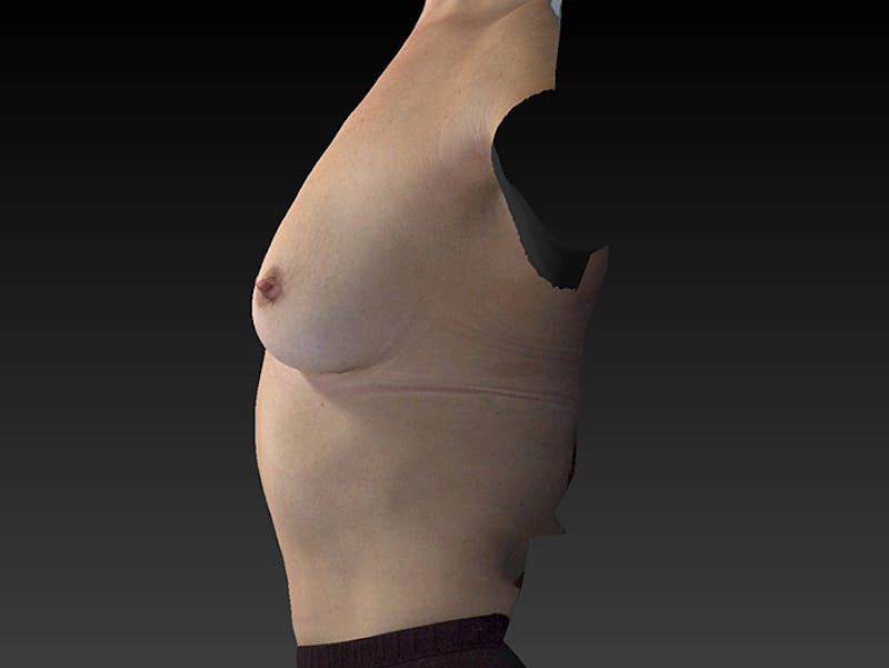 Breast Augmentation Before & After Gallery - Patient 120902542 - Image 9