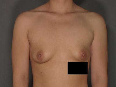 Breast Augmentation Before & After Gallery - Patient 120902545 - Image 1