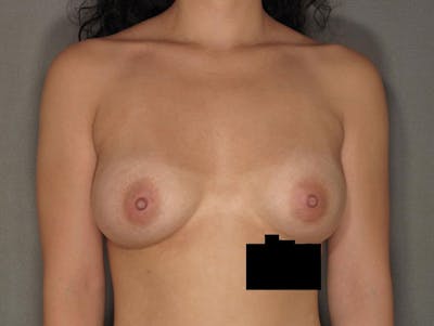 Breast Augmentation Before & After Gallery - Patient 120902545 - Image 2