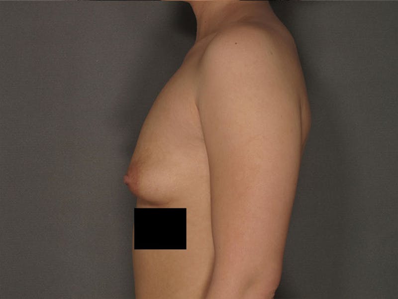 Breast Augmentation Before & After Gallery - Patient 120902545 - Image 5